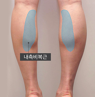 내측비복근