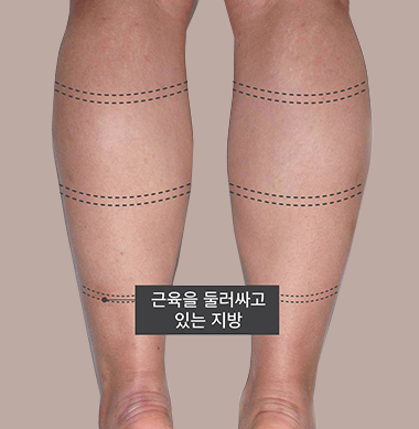 근육을 둘러싸고 있는 지방