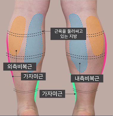 가자미근, 외측비복근, 내측비복근, 근육을 둘러싸고 있는 지방